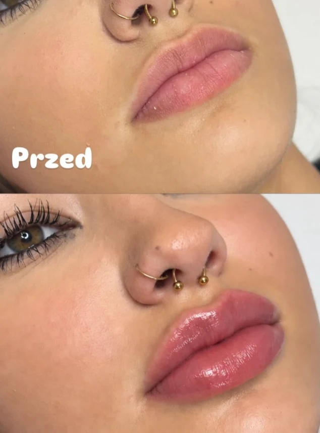 Usta przed zabiegiem z podpisem Przed i po zabiegu